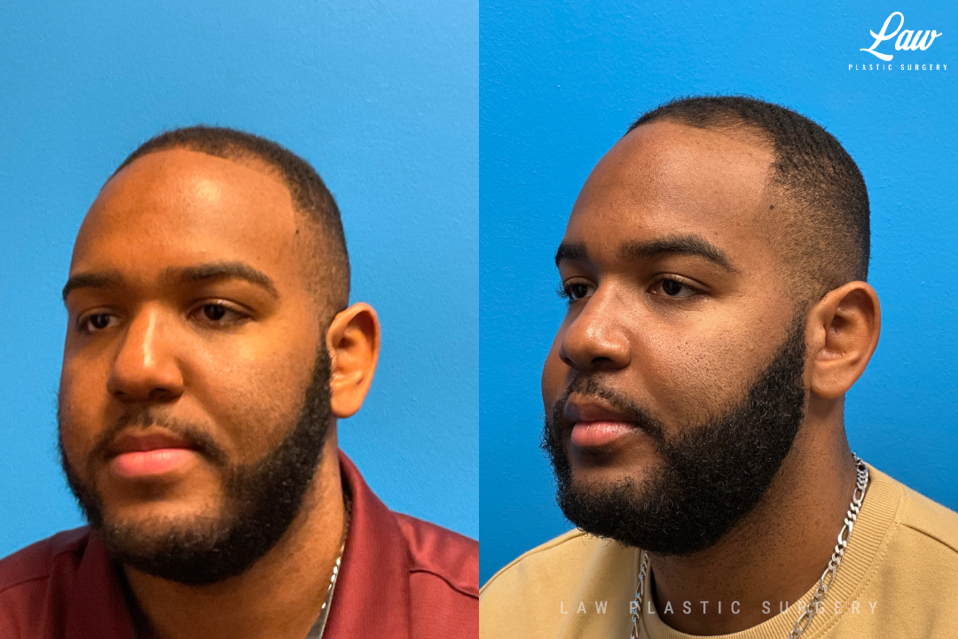 Jaw Surgery Before and After Photo. Surgery performed in Dallas, TX at Law Plastic Surgery.