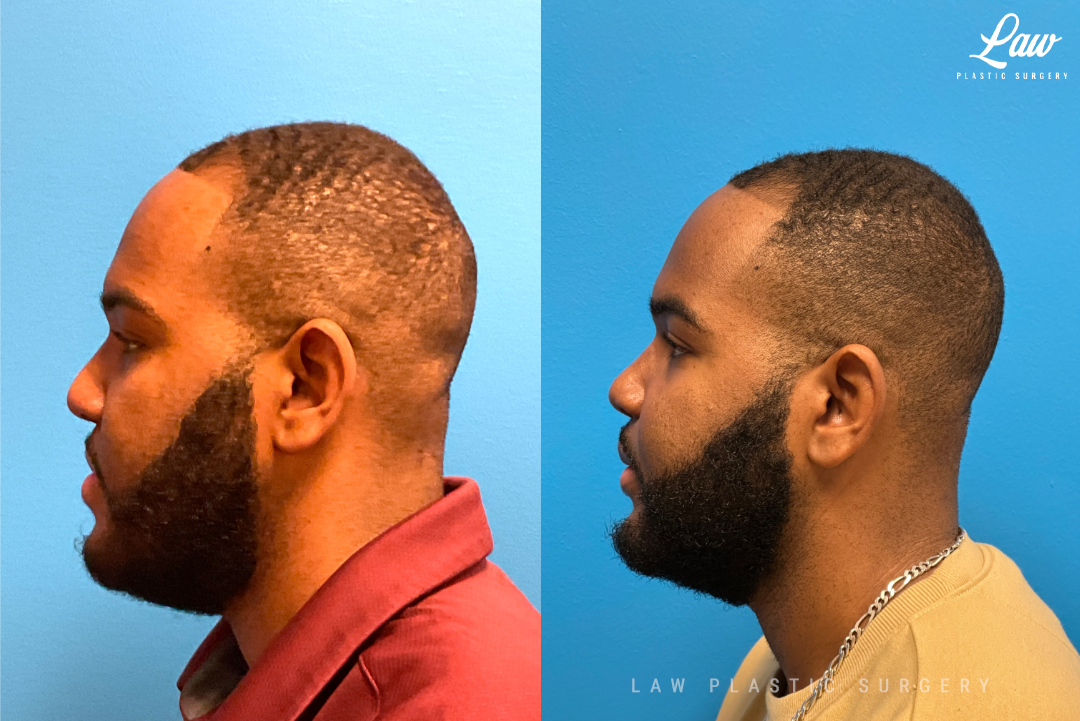 Jaw Surgery Before and After Photo. Surgery performed in Dallas, TX at Law Plastic Surgery.