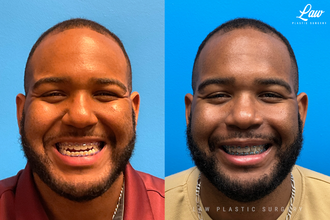 Jaw Surgery Before and After Photo. Surgery performed in Dallas, TX at Law Plastic Surgery.