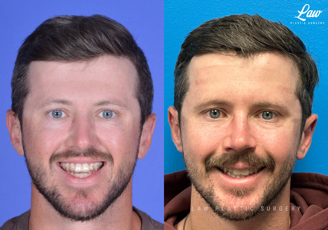 Jaw Surgery Before and After Photo. Surgery performed in Dallas, TX at Law Plastic Surgery.