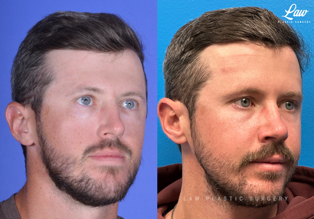 Jaw Surgery Before and After Photo. Surgery performed in Dallas, TX at Law Plastic Surgery.
