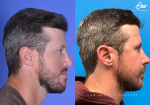 Jaw Surgery Before and After Photo. Surgery performed in Dallas, TX at Law Plastic Surgery.
