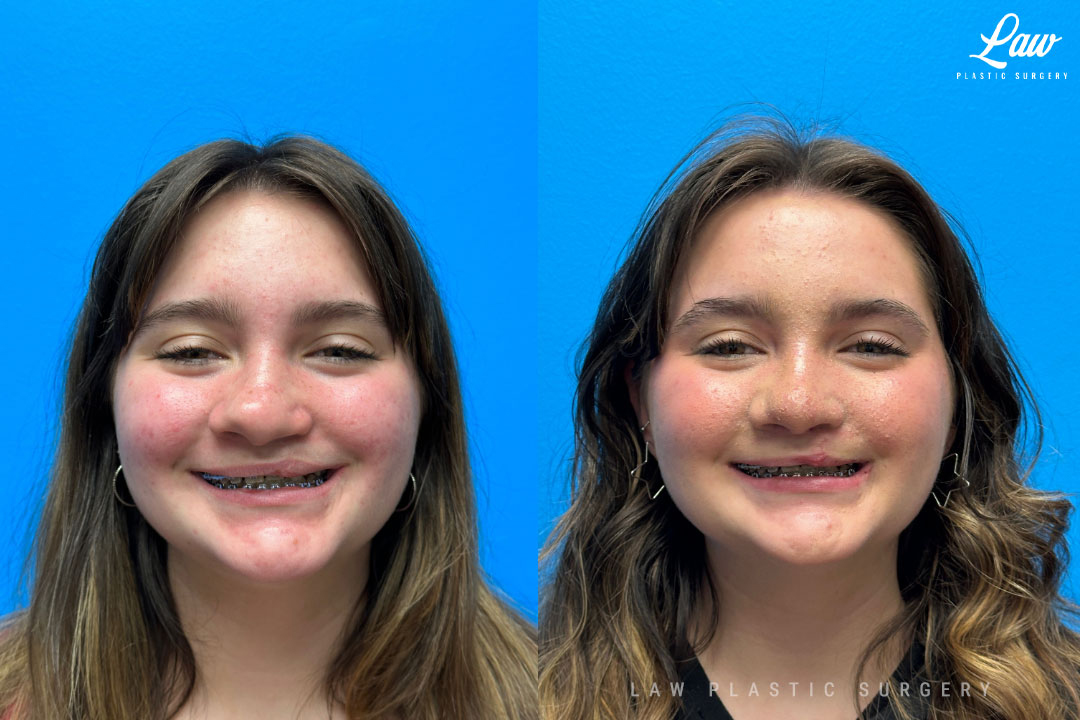 Cleft Rhinoplasty (Cleft Nose Surgery) Before & After Photo. Surgery performed in Dallas, TX at Law Plastic Surgery.