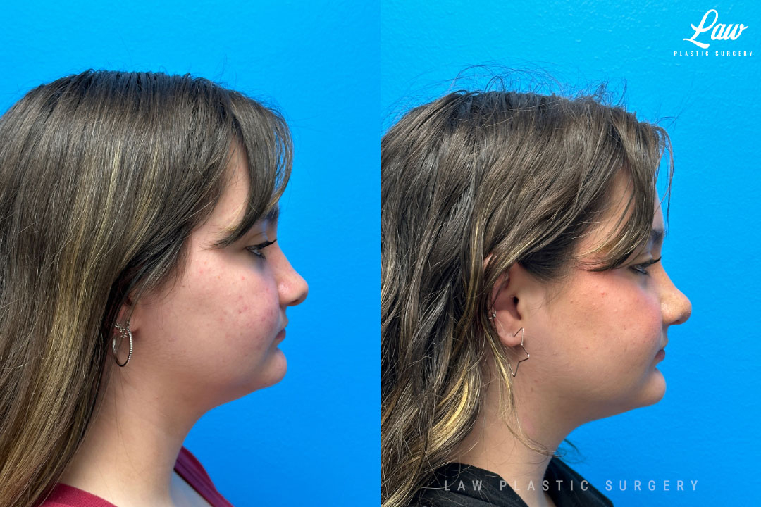 Cleft Rhinoplasty (Cleft Nose Surgery) Before & After Photo. Surgery performed in Dallas, TX at Law Plastic Surgery.