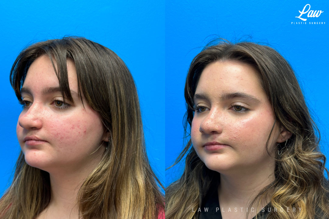 Cleft Rhinoplasty (Cleft Nose Surgery) Before & After Photo. Surgery performed in Dallas, TX at Law Plastic Surgery.