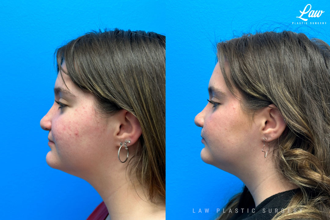 Cleft Rhinoplasty (Cleft Nose Surgery) Before & After Photo. Surgery performed in Dallas, TX at Law Plastic Surgery.