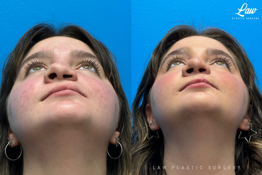 Cleft Rhinoplasty (Cleft Nose Surgery) Before & After Photo. Surgery performed in Dallas, TX at Law Plastic Surgery.