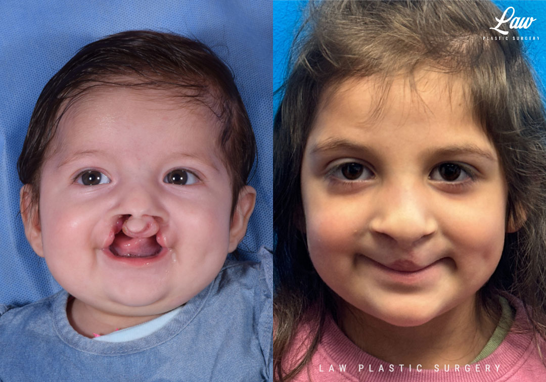 Cleft Lip Repair Before & After Photo. Surgery performed in Dallas, TX at Law Plastic Surgery.