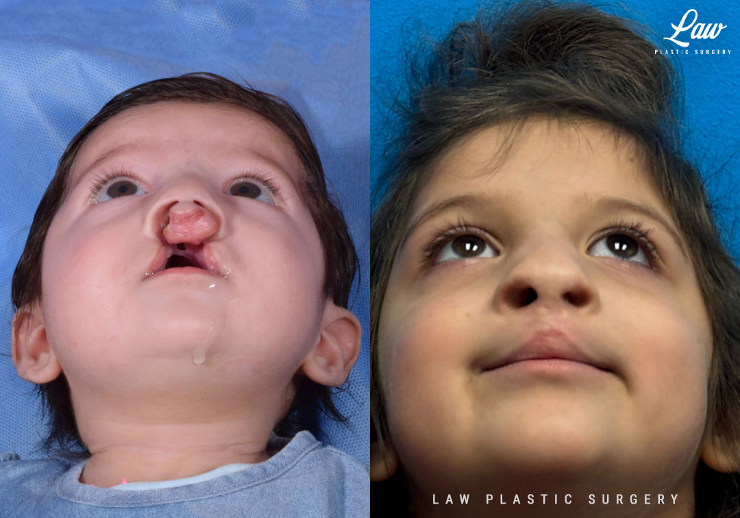 Cleft Lip Repair Before & After Photo. Surgery performed in Dallas, TX at Law Plastic Surgery.