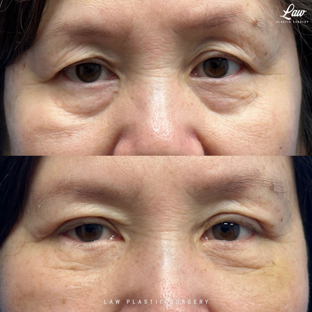 Asian Eyelid Surgery Before & After Photo. Surgery performed in Dallas, TX at Law Plastic Surgery.
