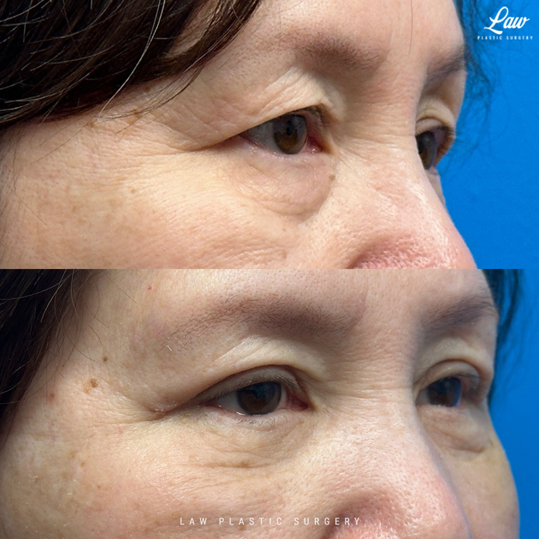 Asian Eyelid Surgery Before & After Photo. Surgery performed in Dallas, TX at Law Plastic Surgery.