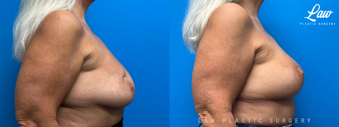 Fat Transfer Breast Augmentation Before and After Photo. Surgery performed in Dallas, TX at Law Plastic Surgery.