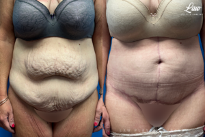 Tummy Tuck (Abdominoplasty) Before and After Photo. Surgery performed in Dallas, TX at Law Plastic Surgery.