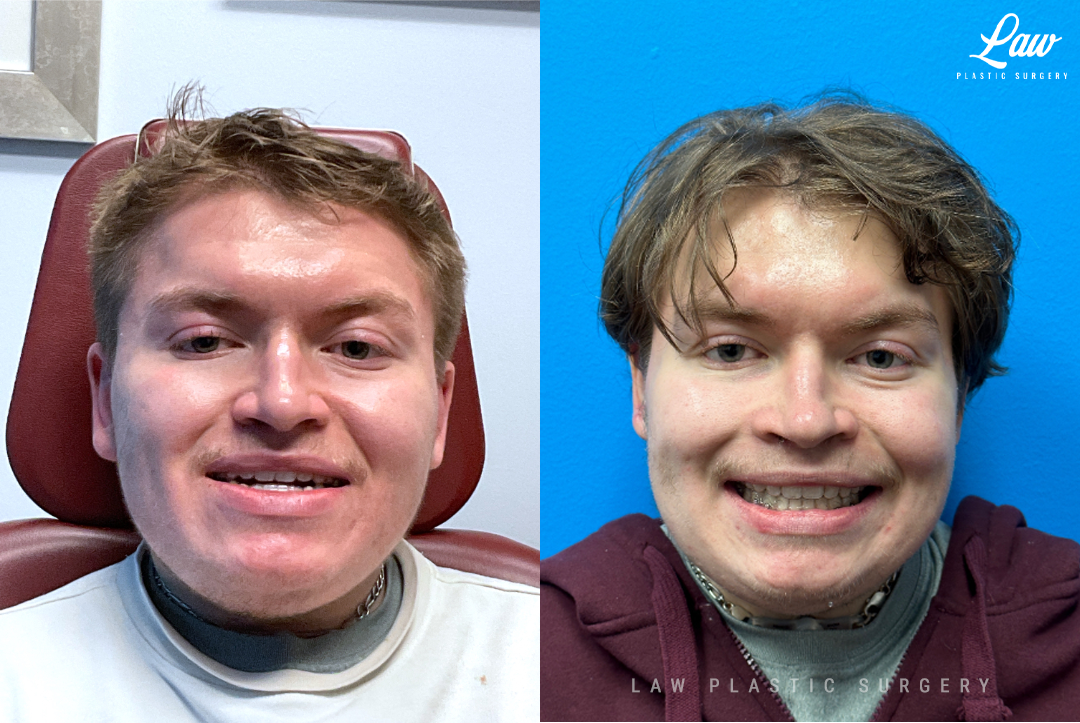 Jaw Surgery Before and After Photo. Surgery performed in Dallas, TX at Law Plastic Surgery.