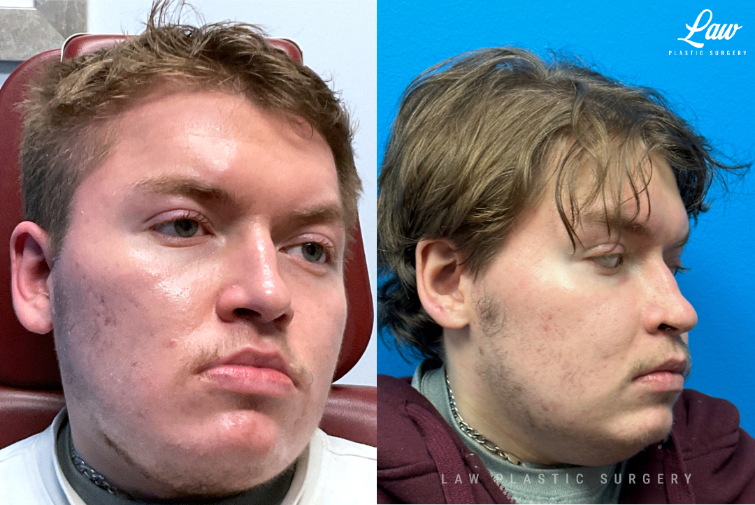 Jaw Surgery Before and After Photo. Surgery performed in Dallas, TX at Law Plastic Surgery.