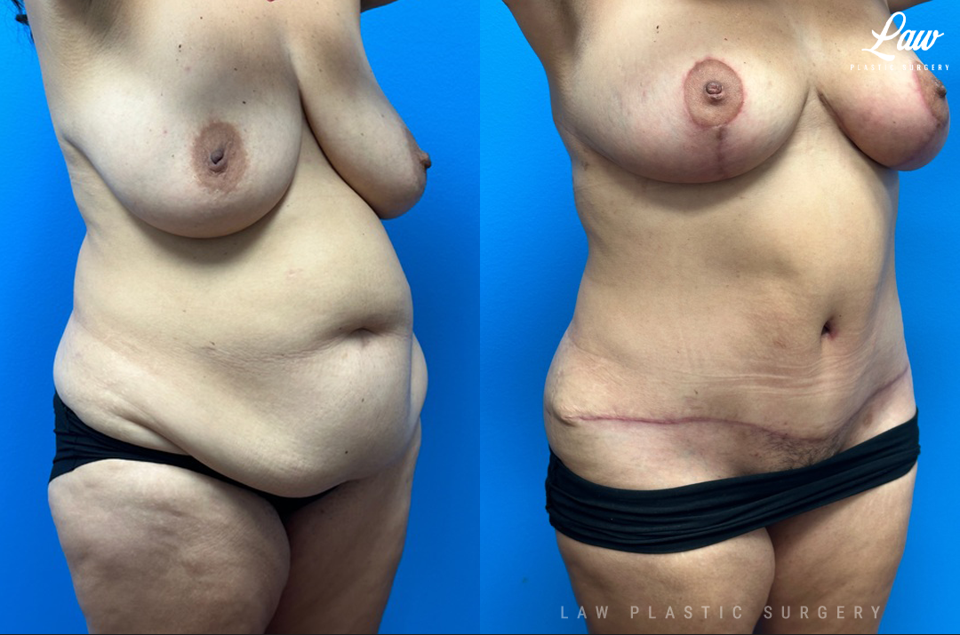 Mommy Makeover Before and After Photo. Surgery performed in Dallas, TX at Law Plastic Surgery.