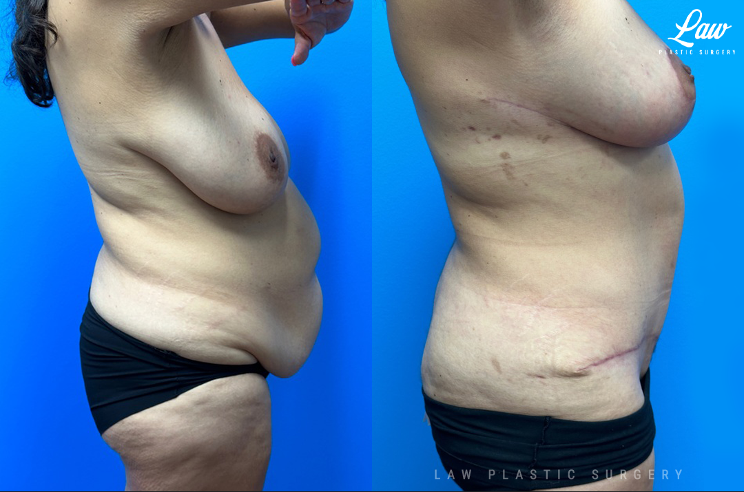 Mommy Makeover Before and After Photo. Surgery performed in Dallas, TX at Law Plastic Surgery.