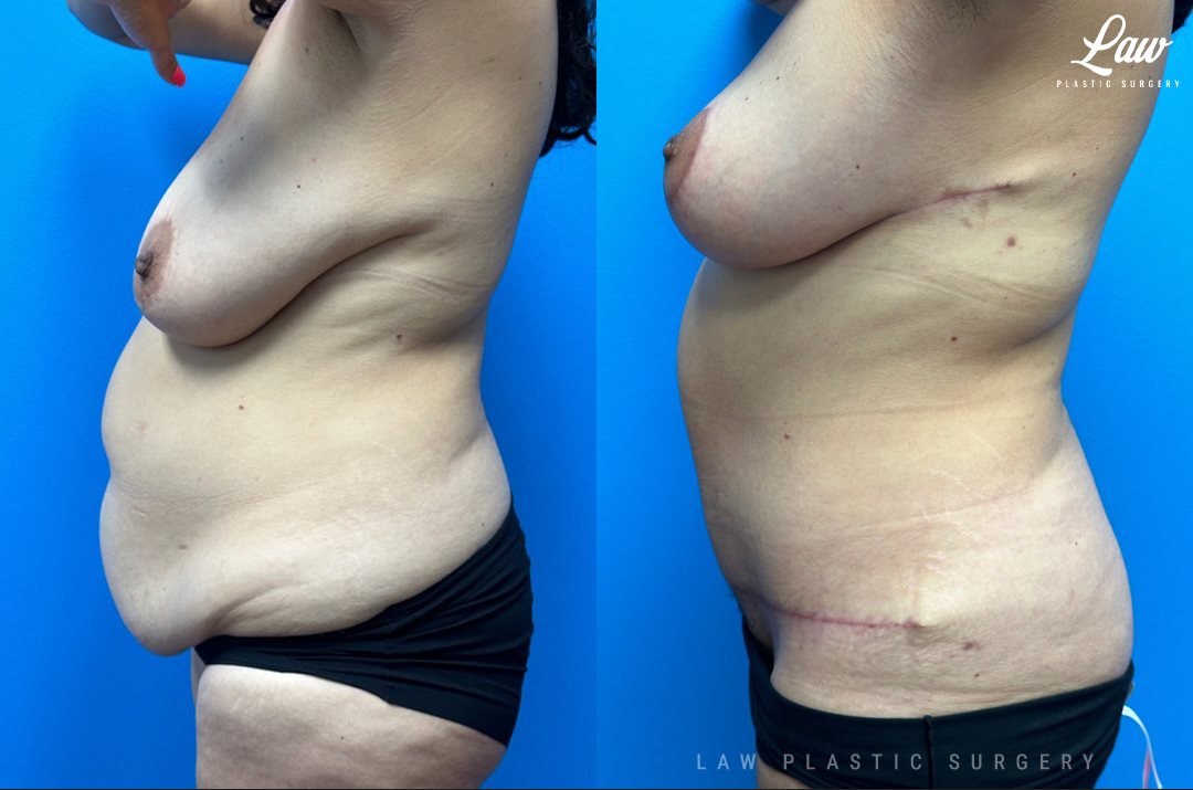 Mommy Makeover Before and After Photo. Surgery performed in Dallas, TX at Law Plastic Surgery.
