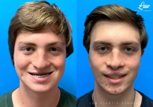 Jaw Distraction Before and After Photo. Surgery performed in Dallas, TX at Law Plastic Surgery.