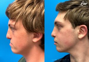 Jaw Distraction Before and After Photo. Surgery performed in Dallas, TX at Law Plastic Surgery.