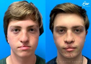 Jaw Distraction Before and After Photo. Surgery performed in Dallas, TX at Law Plastic Surgery.