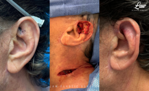 Skin Cancer Reconstruction Before and After Photo. Surgery performed in Dallas, TX at Law Plastic Surgery.