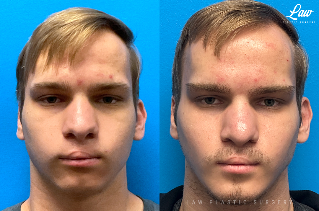 Jaw Surgery Before and After Photo. Surgery performed in Dallas, TX at Law Plastic Surgery.