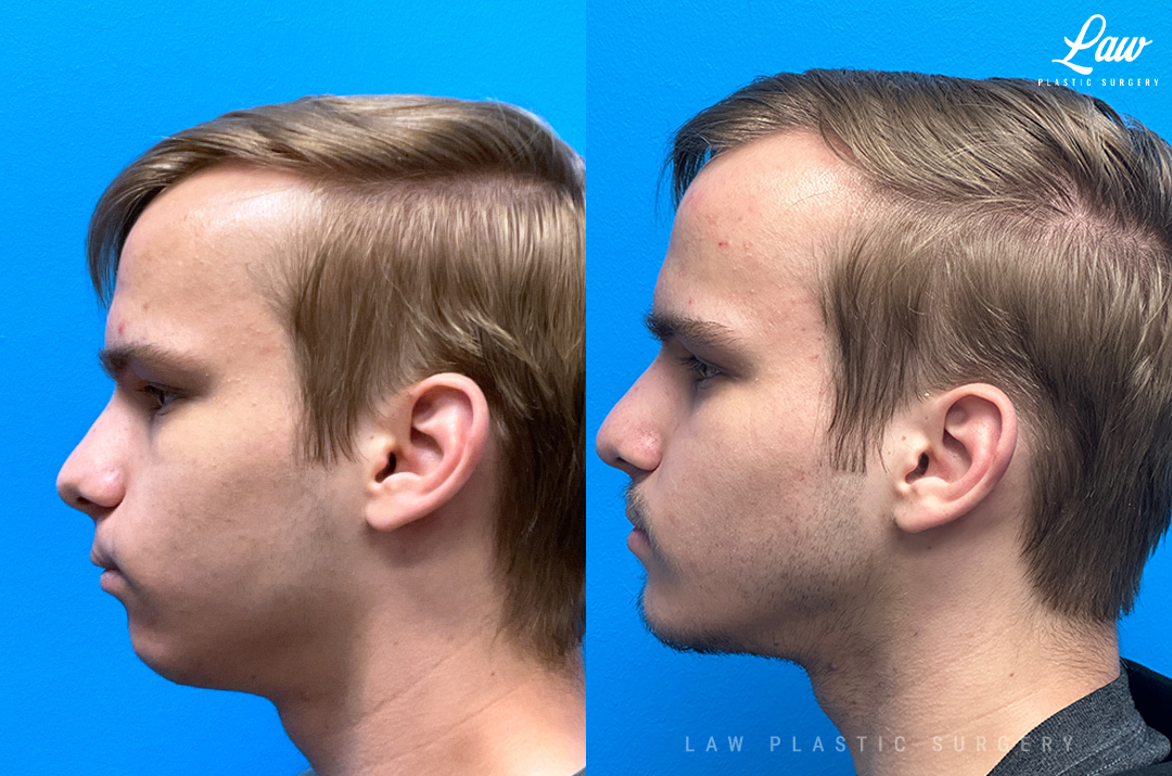 Jaw Surgery Before and After Photo. Surgery performed in Dallas, TX at Law Plastic Surgery.