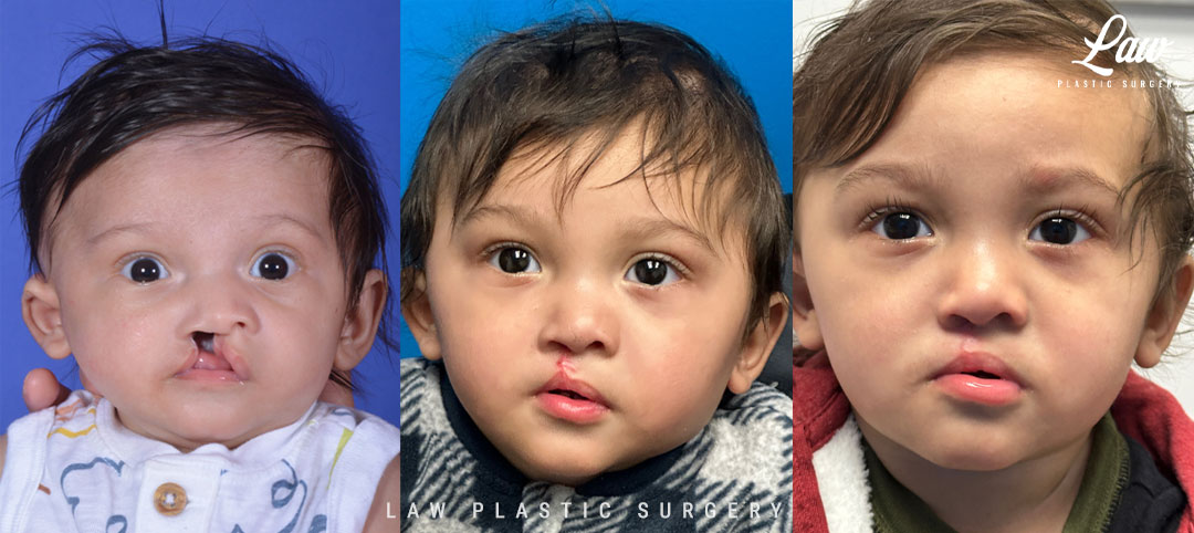 Cleft Lip Repair, Secondary and Adult Before & After Photo. Surgery performed in Dallas, TX at Law Plastic Surgery.