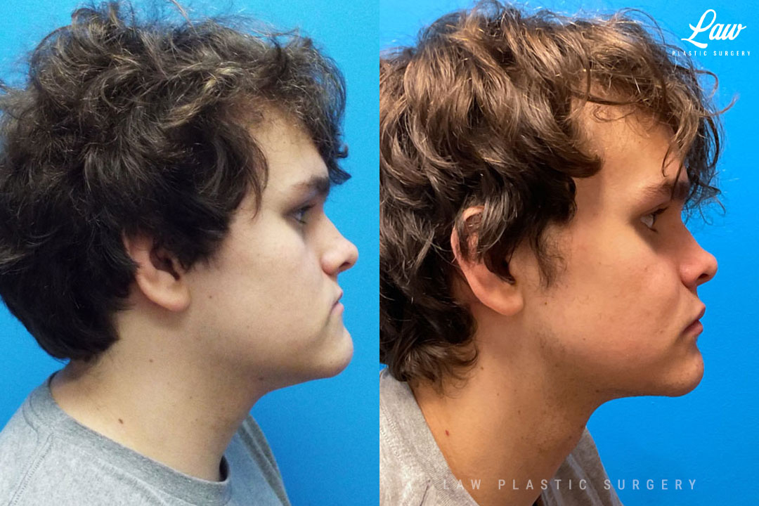 Jaw Surgery Before and After Photo. Surgery performed in Dallas, TX at Law Plastic Surgery.