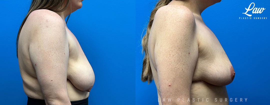 Breast Reduction Before and After Photo. Surgery performed in Dallas, TX at Law Plastic Surgery.
