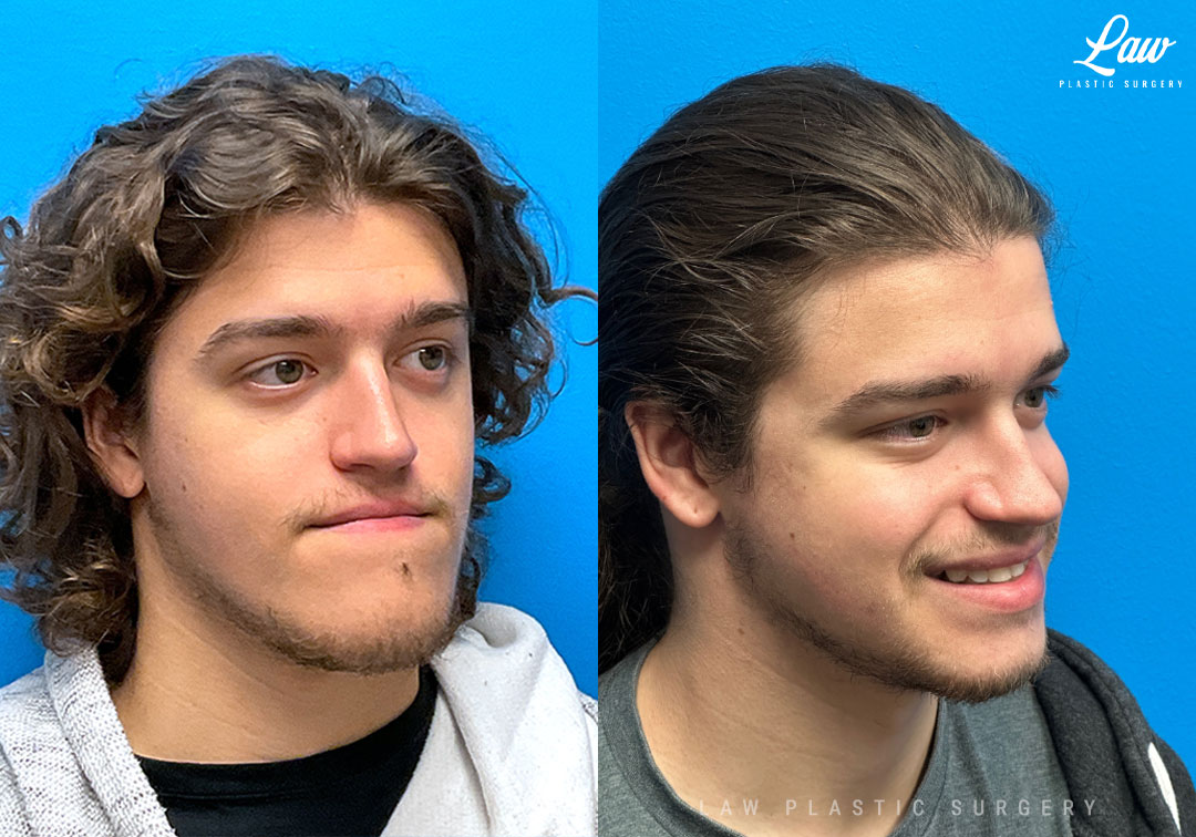 Jaw Surgery Before and After Photo. Surgery performed in Dallas, TX at Law Plastic Surgery.