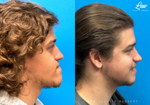 Jaw Surgery Before and After Photo. Surgery performed in Dallas, TX at Law Plastic Surgery.