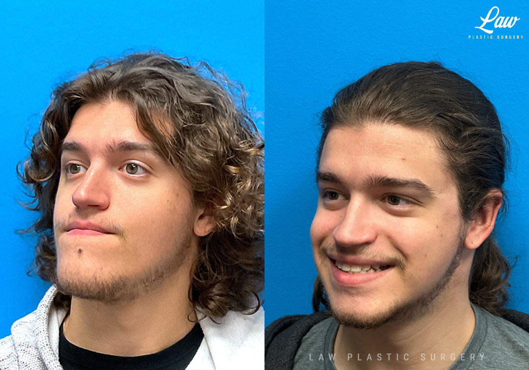 Jaw Surgery Before and After Photo. Surgery performed in Dallas, TX at Law Plastic Surgery.
