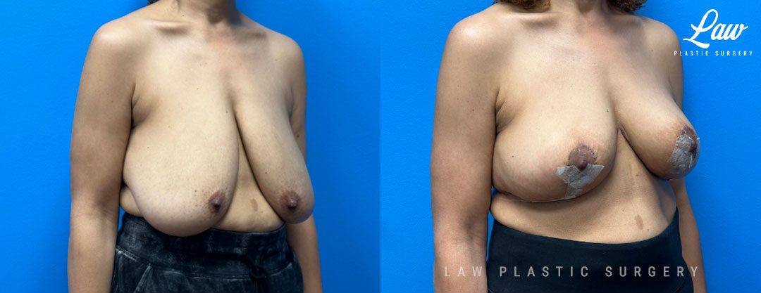 Breast Lift (Mastopexy) Before and After Photo. Surgery performed in Dallas, TX at Law Plastic Surgery.