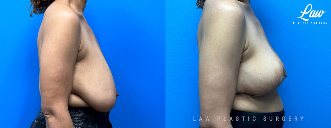 Breast Lift (Mastopexy) Before and After Photo. Surgery performed in Dallas, TX at Law Plastic Surgery.