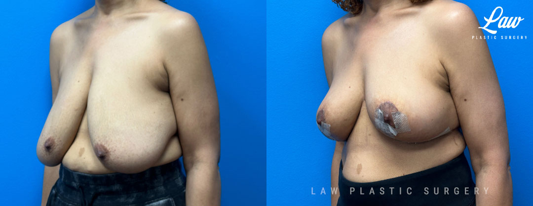 Breast Lift (Mastopexy) Before and After Photo. Surgery performed in Dallas, TX at Law Plastic Surgery.