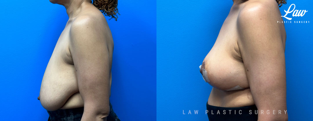 Breast Lift (Mastopexy) Before and After Photo. Surgery performed in Dallas, TX at Law Plastic Surgery.