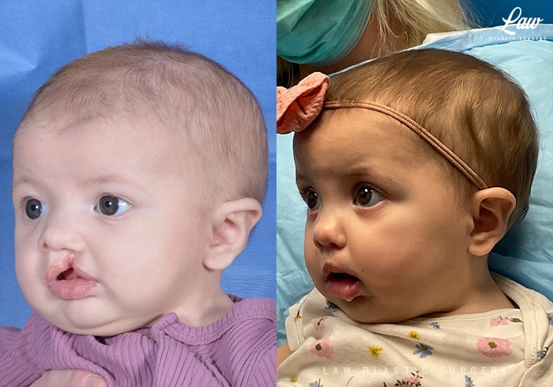 Cleft Lip Repair Before & After Photo. Surgery performed in Dallas, TX at Law Plastic Surgery.