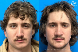 Jaw Surgery Before and After Photo. Surgery performed in Dallas, TX at Law Plastic Surgery.