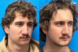 Jaw Surgery Before and After Photo. Surgery performed in Dallas, TX at Law Plastic Surgery.