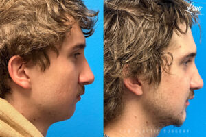 Jaw Surgery Before and After Photo. Surgery performed in Dallas, TX at Law Plastic Surgery.