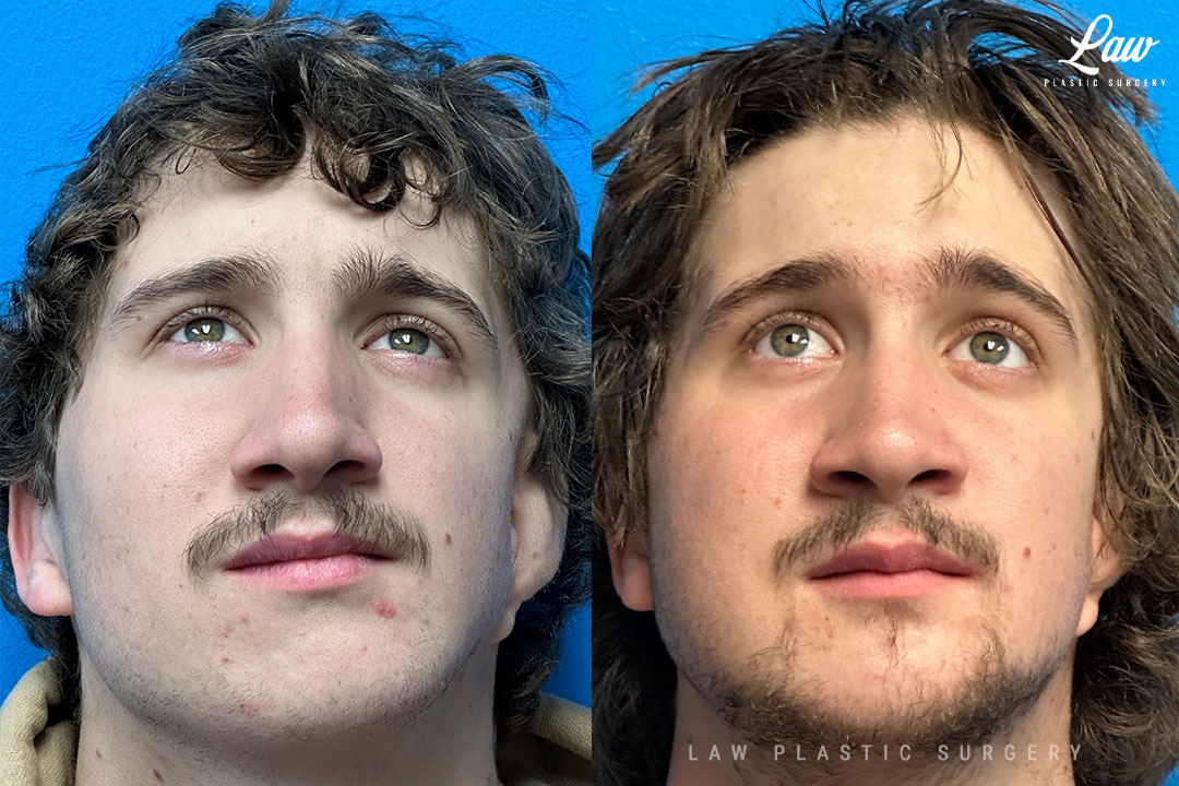 Jaw Surgery Before and After Photo. Surgery performed in Dallas, TX at Law Plastic Surgery.