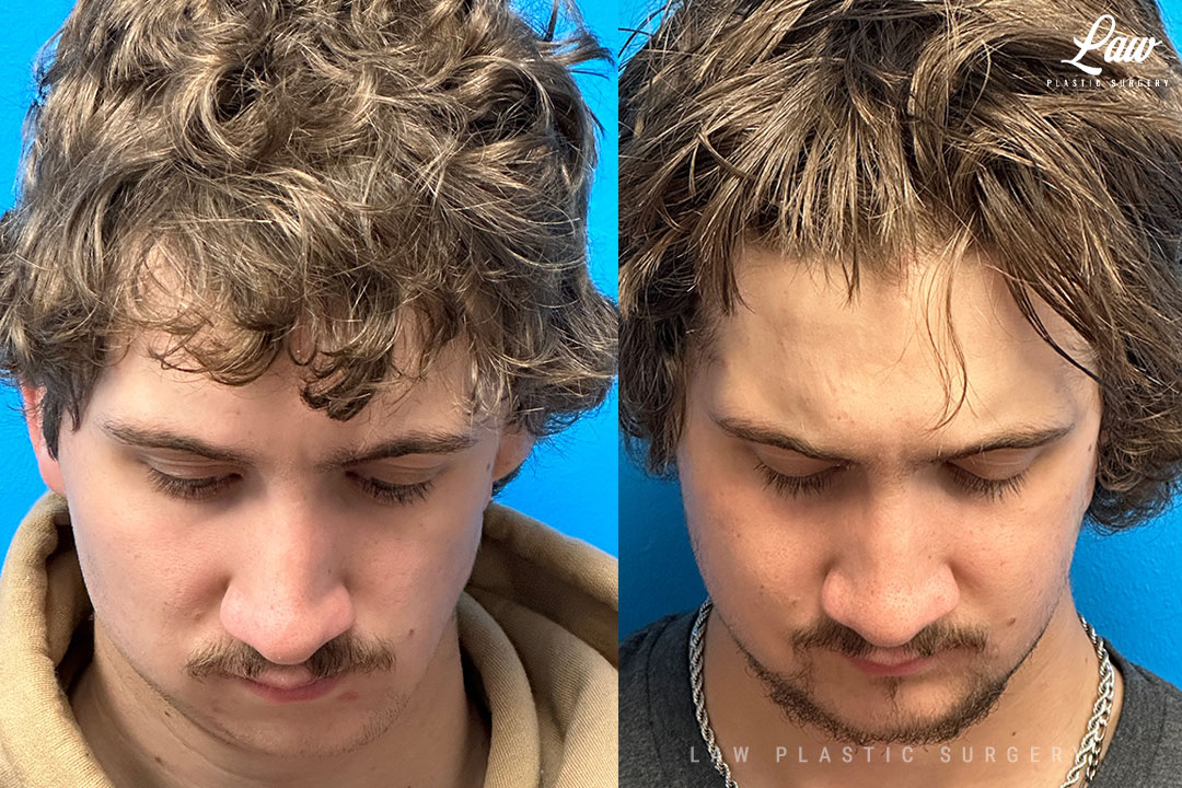 Jaw Surgery Before and After Photo. Surgery performed in Dallas, TX at Law Plastic Surgery.