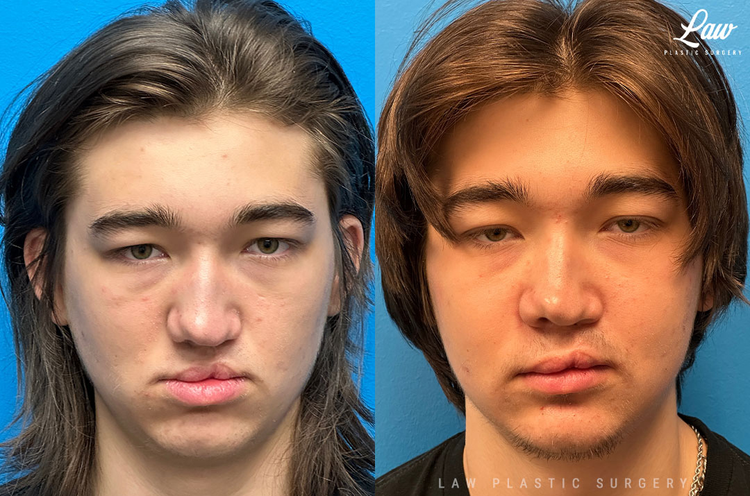 Jaw Surgery Before and After Photo. Surgery performed in Dallas, TX at Law Plastic Surgery.