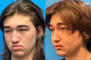 Jaw Surgery Before and After Photo. Surgery performed in Dallas, TX at Law Plastic Surgery.