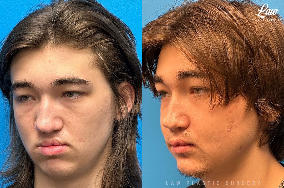 Jaw Surgery Before and After Photo. Surgery performed in Dallas, TX at Law Plastic Surgery.