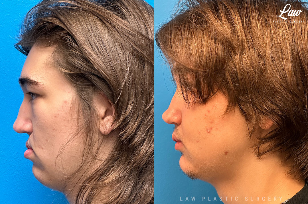 Jaw Surgery Before and After Photo. Surgery performed in Dallas, TX at Law Plastic Surgery.