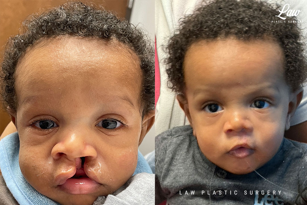 Cleft Lip Repair Before & After Photo. Surgery performed in Dallas, TX at Law Plastic Surgery.