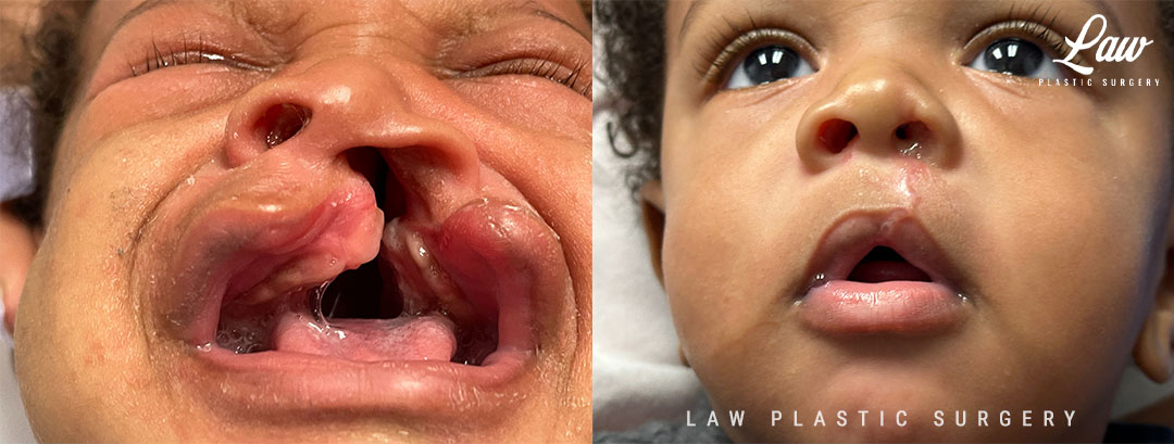 Cleft Lip Repair Before & After Photo. Surgery performed in Dallas, TX at Law Plastic Surgery.